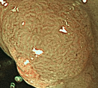 NBI拡大観察(血管が目立たない)