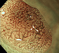 NBI拡大観察(整った血管模様を認める)