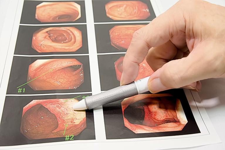 小腸カプセル内視鏡検査