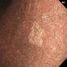 NBI通常観察の写真