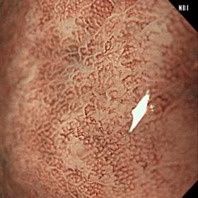 NBI拡大観察の写真